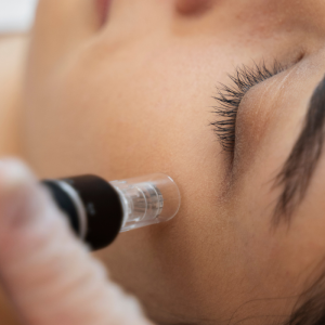 Level 4 Microneedling Course